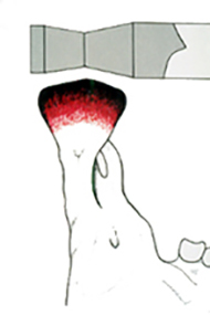 Condylator Joints