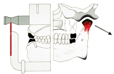 Condylator Joins